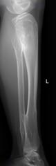 Osteochondroma  and  Multiple Hereditary Exostosis x ray 