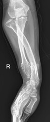 Osteochondroma  and  Multiple Hereditary Exostosis x ray 