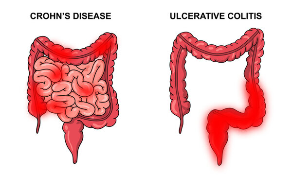 Illustration of Crohn's disease and ulcerative colitis.  inflammatory bowel disease, Inflammation of the human digestive system. Vector illustration for medical, science, and educational posters.