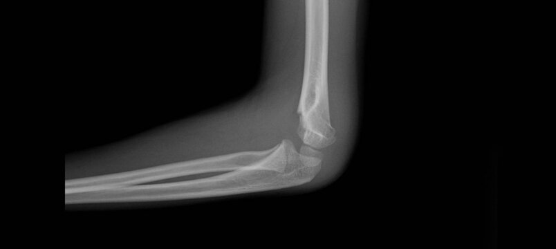 Pediatric elbow x-ray showing supracondylar fracture of distal humerus. Lateral view radiograph for diagnostic examination of elbow trauma and fracture in children