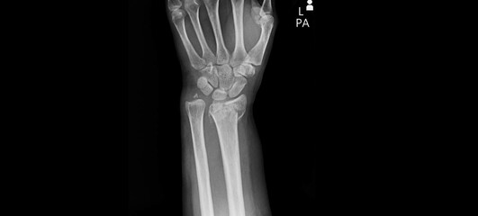 Wrist x-ray showing radius, ulna, carpal bones and hand. PA view plain film radiograph for diagnostic examination of wrist joint anatomy and bone structure