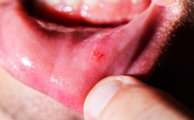 Fototapeta premium Close-up of a painful ulcer inside the mouth on a man's lip, macro, stomatitis