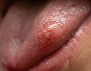 A person's tongue is red and swollen
