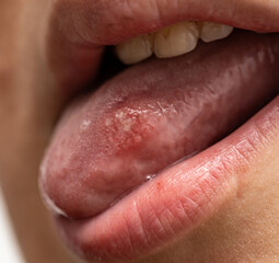 A woman's tongue is red and swollen