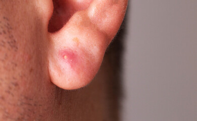 Red bump on the earlobe of a person, indicating a possible skin condition or irritation, red pimple