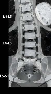 Analyzing Human Spine Anatomy with Medical Imaging