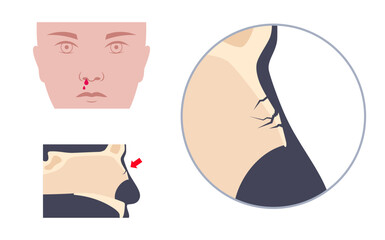 Nasal fracture poster