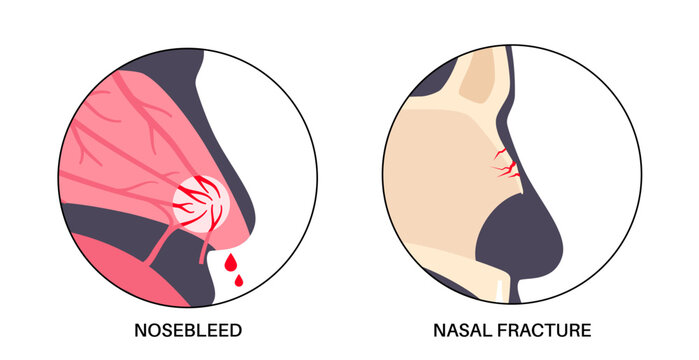 Nasal fracture poster