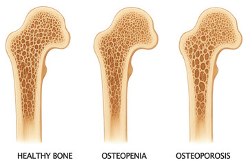 Medical Illustration of Healthy Bone Versus Osteoporotic Bone Density Comparison osteoporosis isolated on a transparent background