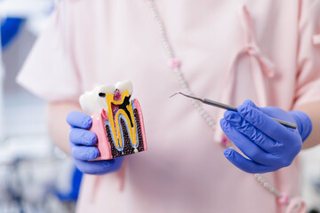 Female dentist holding tooth model showing caries and nerve canal problems and dental tool for educational demonstration