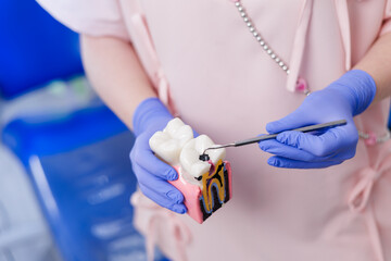 Top view Female dentist demonstrating tooth anatomy model with caries and nerve canal problems showing with tools