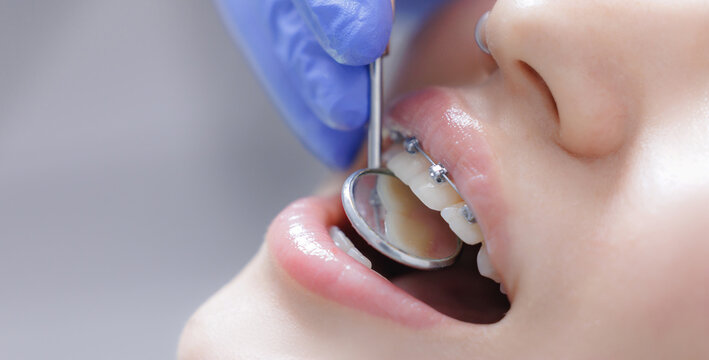 Close-up of dental check-up on young caucasian individual with braces