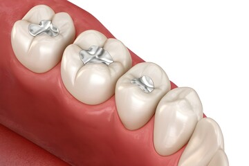3D illustration of lower molars with amalgam dental fillings