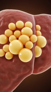 Fatty liver disease visualization with accumulating fat globules