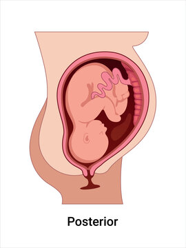 Posterior Baby Positions in the Uterus during Pregnancy. Pathology. Detailed Medical vector illustration. 
