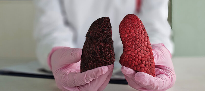 Lungs transplant and disease concept