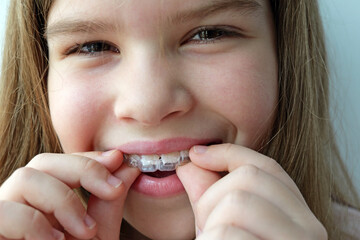 Teen girl adjusting transparent aligners on her teeth, demonstrating easy at home orthodontic use. Aligner comfort, children dentistry and teeth straightening solutions