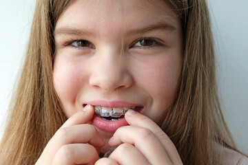 Smiling teen adjusting aligners with her hands, showing process of wearing removable orthodontic devices. Ideal for ads about aligner systems, dental hygiene practices and kids orthodontic services
