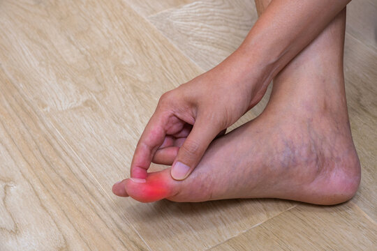 Close-up of injured big toe with redness and swelling&mdash;ideal for ads on wound care, pain relief, or first aid treatment. Copy space for your project.