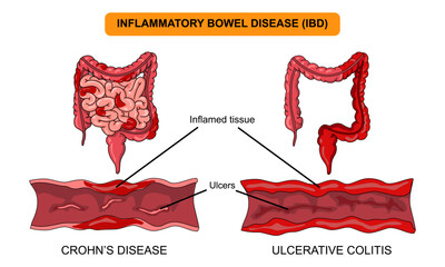 Illustration of inflammatory bowel disease. Crohn's disease and ulcerative colitis. Inflammation of the human digestive system. Vector illustration for medical, science, and educational posters.