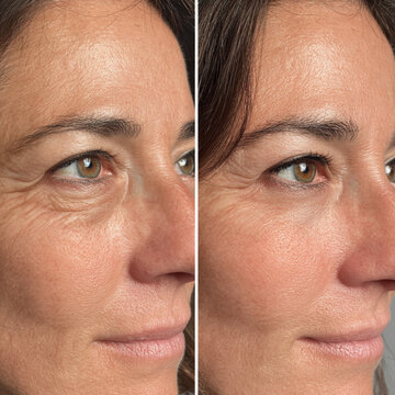 Side-by-Side Before and After Eye Transformation of Middle-Aged Woman Using Red Light Therapy for Dark Circles and Puffiness