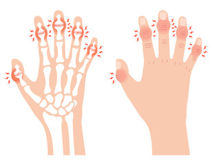 へバーデン結節　指の関節の病気