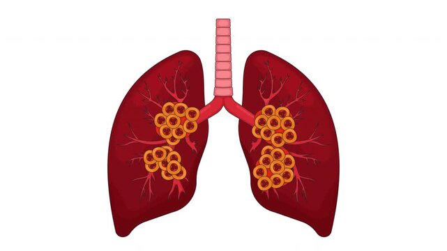 Human lungs affected by late-stage cancer cartoon animation. Malignant cells. Alveoli oncology. Tumor growths in branching bronchi breathing animated flat 2D object 4K video isolated on white