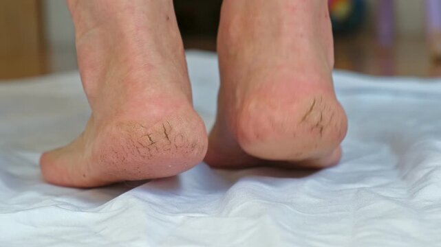 Cracked heel of a female foot with small bleedings and wounds. Dry Skin crack on womans or mans foot heel. Close-Up. Foot Care, Skincare, and Pedicure Concept with Flaky Skin and Calluses. Real video