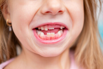 smiling child's mouth showing gap from missing milk teeth, baby teeth, growth and development, visit Tooth Fairy, joyful expression, childhood development, front teeth losing, innocence and transition