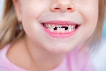 smiling child's mouth showing gap from missing milk teeth, baby teeth, growth and development, visit Tooth Fairy, joyful expression, childhood development, front teeth losing, innocence and transition