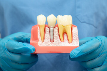 Dental implant, artificial tooth roots into jaw, root canal of dental treatment, gum disease, teeth model for dentist studying about dentistry.