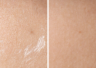 Fototapeta premium Dry skin before and after moisturizing, marco view. Collage for comparison