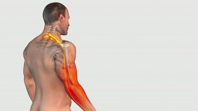 Cervical C7 Radiculopathy Animation Showing Arm Symptoms