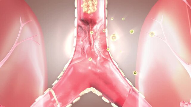 Expectorant and cough suppressant, medication for bronchial inflammation and airway narrowing, asthma treatment, airway clearing, lung health restoration. Respiratory disease solutions, 3D animation.