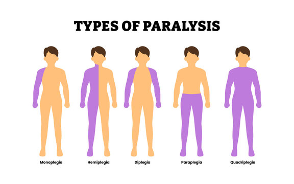Different types of paralysis types. Labeled monoplegia, hemiplegia, diplegia, paraplegia, quadriplegia. Loss of motor function. Nervous system damage. Rehabilitation therapy. Vector illustration.