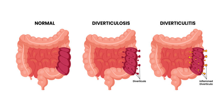 Different types of Bowel colon cancer, labeled healthy colon, diverticulosis, diverticulitis with colonoscopy. Diverticula, rectum, sigmoid colon. Colorectal colon. Medical illustration vector.