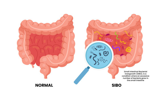 SIBO or small intestinal bacterial overgrowth. Excessive number of bacteria grow in small intestine. olon Rectal vomiting spastic mucous colitis viral acid level celiac abdomen yeast system germs.