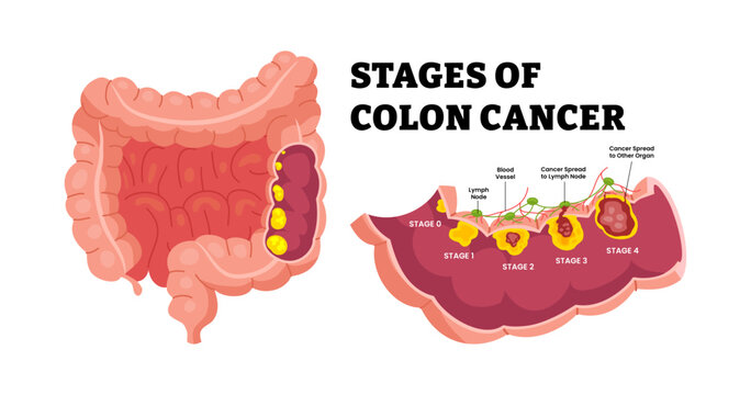 Stages of colon cancer stages. Labeled polyps and colon cross section view. Colon anatomy, lymph node, blood vessel, cancer spread. Medical science  educational illustration. From stage 0 to 4.