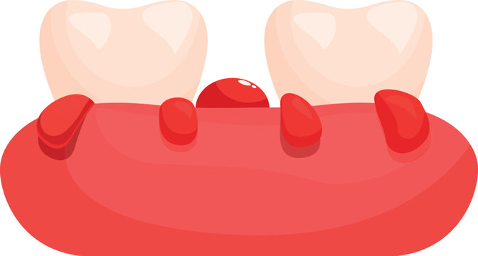 Cartoon illustration of inflamed and bleeding gums with two teeth and epulis