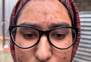 Detailed Close-Up of Facial Acne, Scars, and Hyperpigmentation. Inflamed Acne and Pigmentation Marks on woman face. Young girl facing skin problem as red bumps dark spots on her face