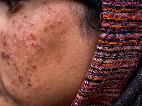 Detailed Close-Up of Facial Acne, Scars, and Hyperpigmentation. Inflamed Acne and Pigmentation Marks on woman face. Young girl facing skin problem as red bumps dark spots on her face