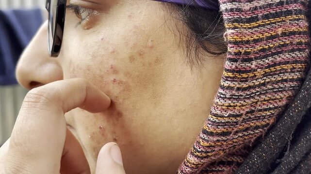 Detailed Close-Up of Facial Acne, Scars, and Hyperpigmentation. Inflamed Acne and Pigmentation Marks on woman face. Young girl facing skin problem as red bumps dark spots on her face