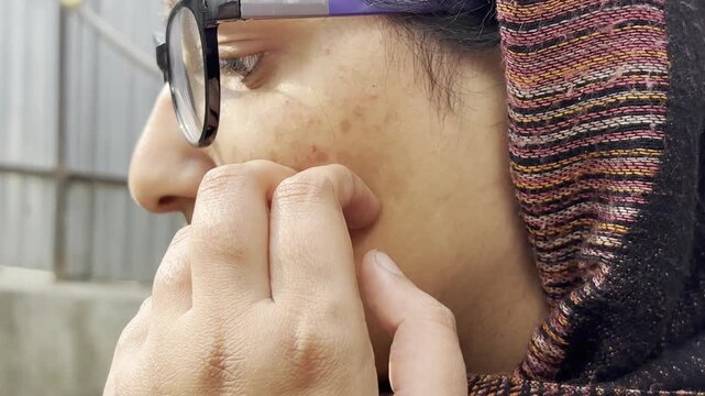 Detailed Close-Up of Facial Acne, Scars, and Hyperpigmentation. Inflamed Acne and Pigmentation Marks on woman face. Young girl facing skin problem as red bumps dark spots on her face