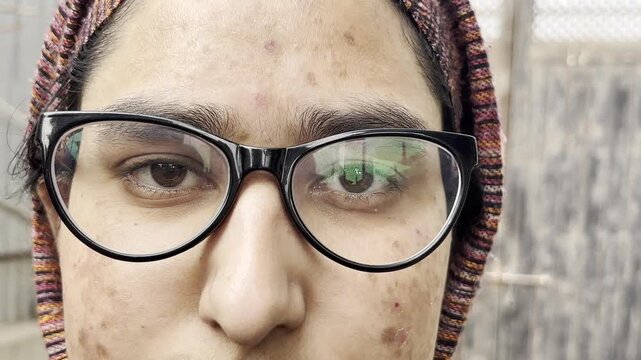 Detailed Close-Up of Facial Acne, Scars, and Hyperpigmentation. Inflamed Acne and Pigmentation Marks on woman face. Young girl facing skin problem as red bumps dark spots on her face
