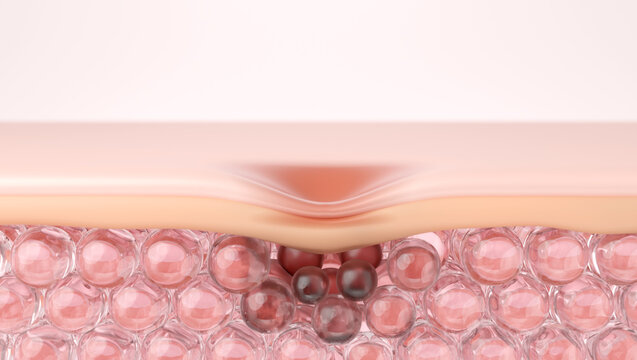 Melanin Hyperpigmentation and Acne Scar Depression on Skin, 3D Illustration