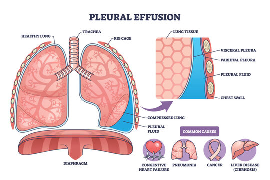 Pleural effusion diagram depicts fluid in pleural space compressing a lung, with labeled pleura layers and causes, key objects, lungs, pleural fluid, diaphragm. Outline diagram