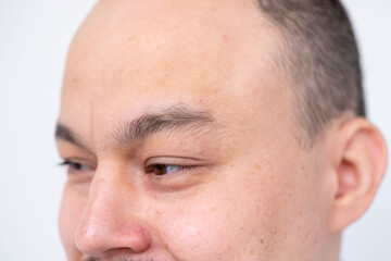 Obraz premium Closeup portrait part man's face 30-35 years old with brown eyes and shaved head, male baldness and growing need professional hair restoration, natural skin texture, intensity glance, human forehead