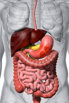 Human Digestive System Anatomy with Stomach Lesion: 3D Medical Illustration Showing the Liver, Esophagus, Intestines, and Gastric Ulcer or Cancer in the Stomach.