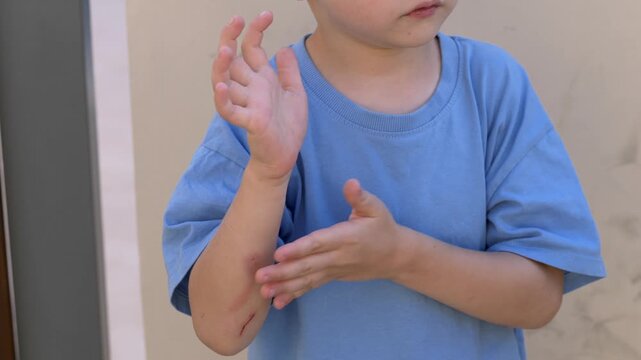 Child bends arm to look closely at fresh elbow scrape, examining redness and irritated skin with curiosity. Raw abrasion, and typical childhood injury. Injury awareness, health education, and safety. 