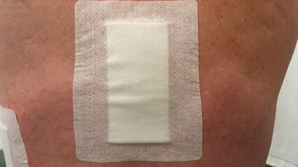 Postoperative Back With Dressings, Scars and Stitches
